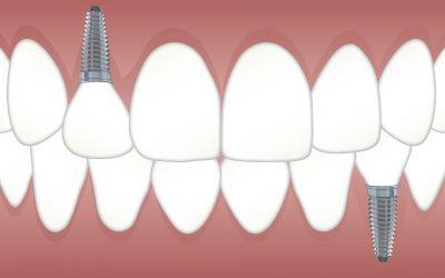 Wat is de beste manier om je implantaten te reinigen?