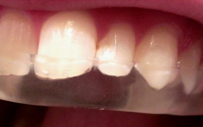 Tandheelkunde bij kromme tanden en een over- of onderbeet